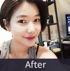 에스탑의원 화곡점 화곡필러 화곡동필러 화곡동보톡스 화곡보톡스 리얼리뷰
