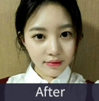 에스탑의원 화곡점 화곡필러 화곡동필러 화곡동보톡스 화곡보톡스 리얼리뷰