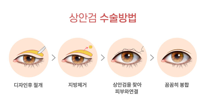 상안검 수술방법