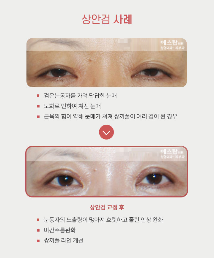 상안검 사례
