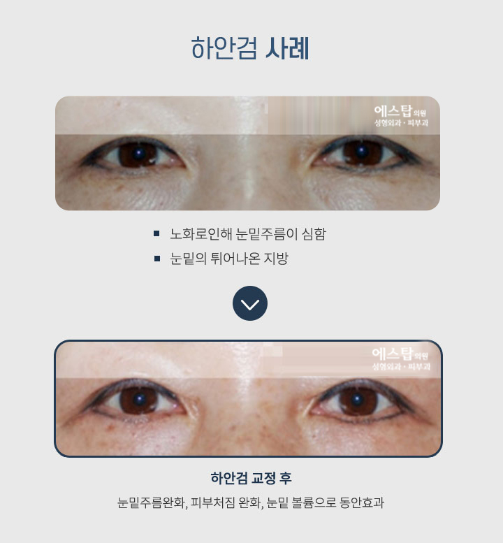 하안검 사례