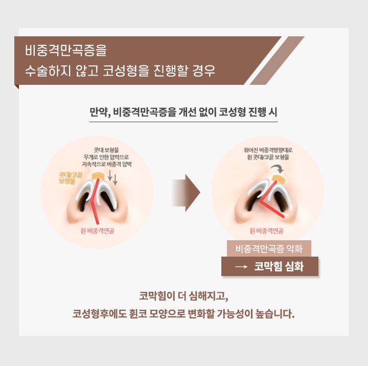 비중격만곡증을 수술하지 않고 코성형을 진행할 경우