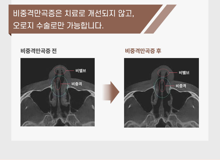 비중격만곡증은 치료로 개선되지 않고, 오로지 수술로만 가능하다