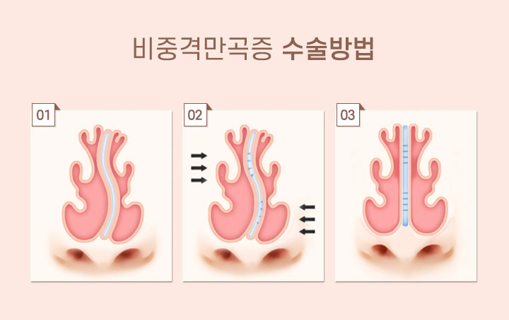 비중격만곡증 수술방법