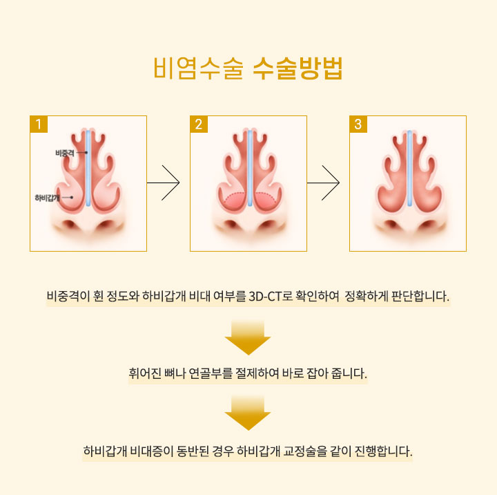 비염수술 수술방법