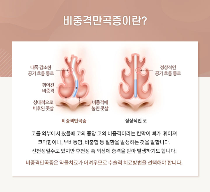 비중격만곡증이란