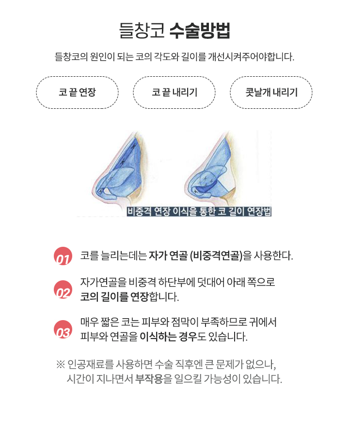 들창코 수술방법
