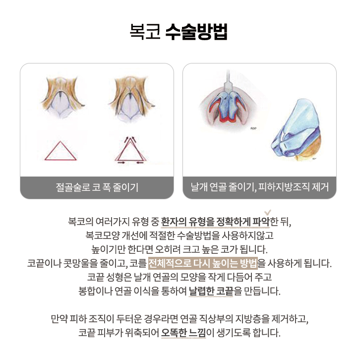 복코 수술방법