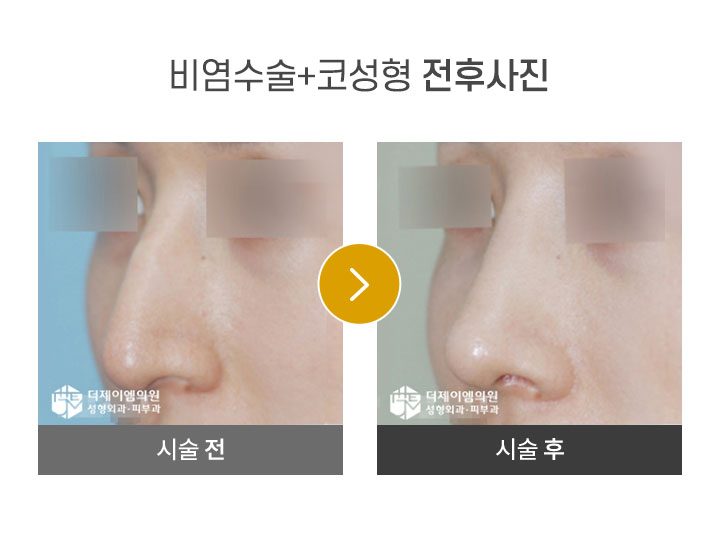 비염코성형 전후사진