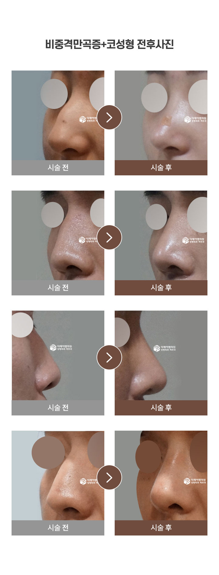 비중격만곡증 전후사진