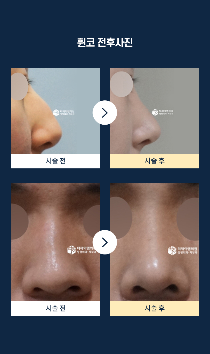 휜코