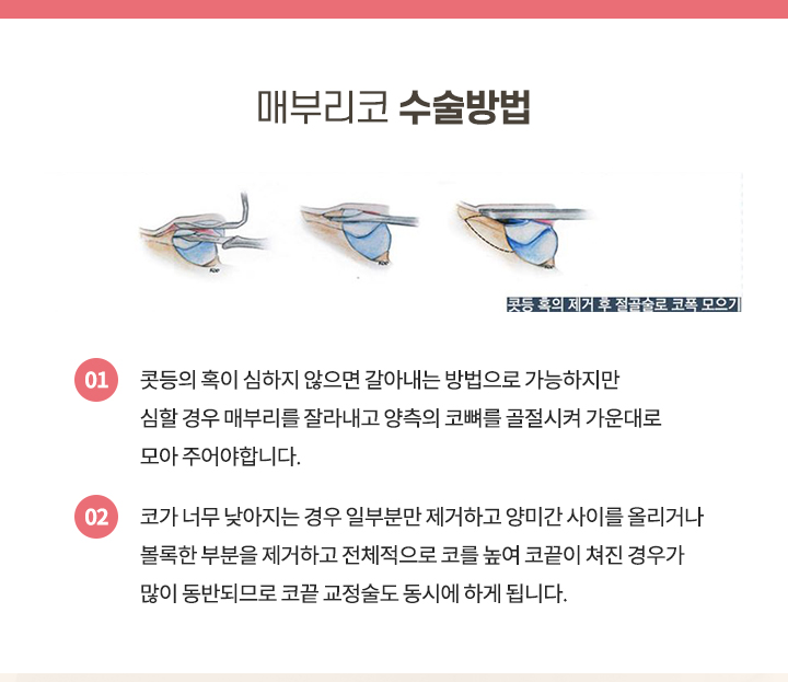 매부리코