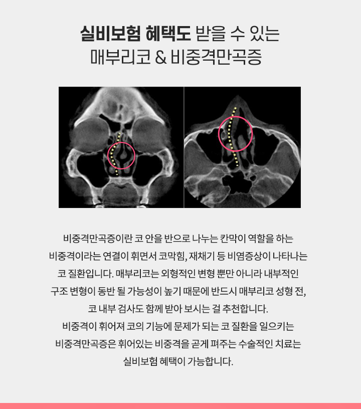 매부리코