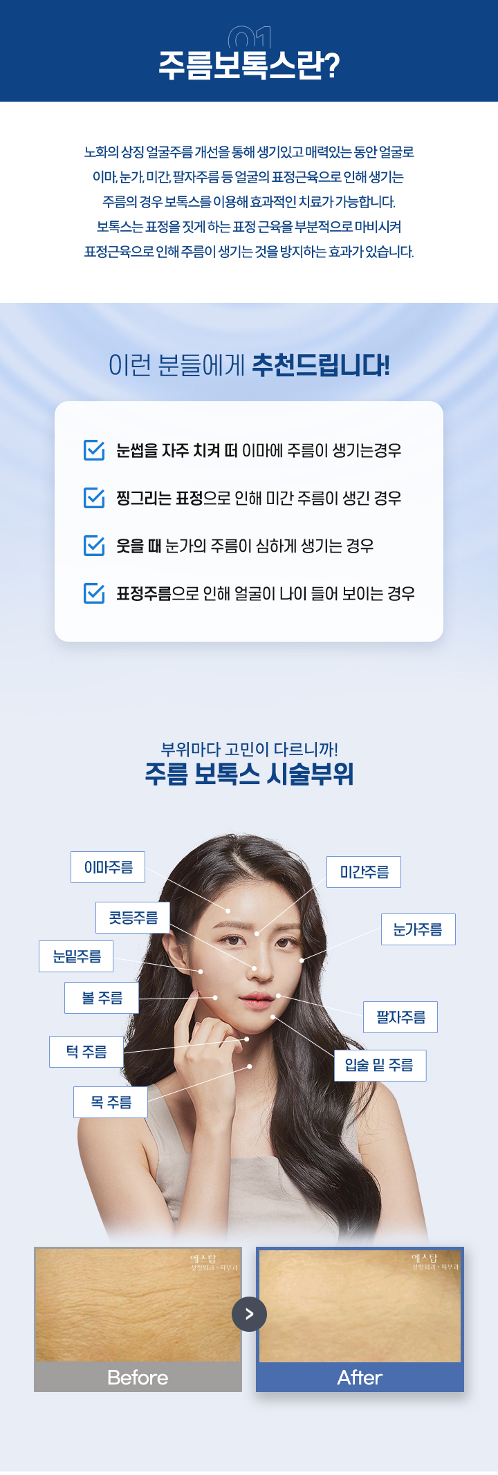 주름보톡스란