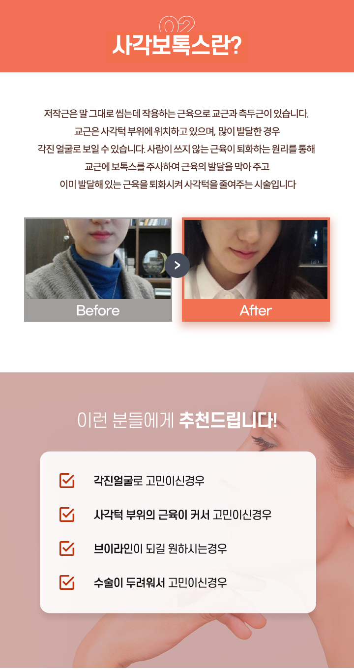 사각보톡스란
