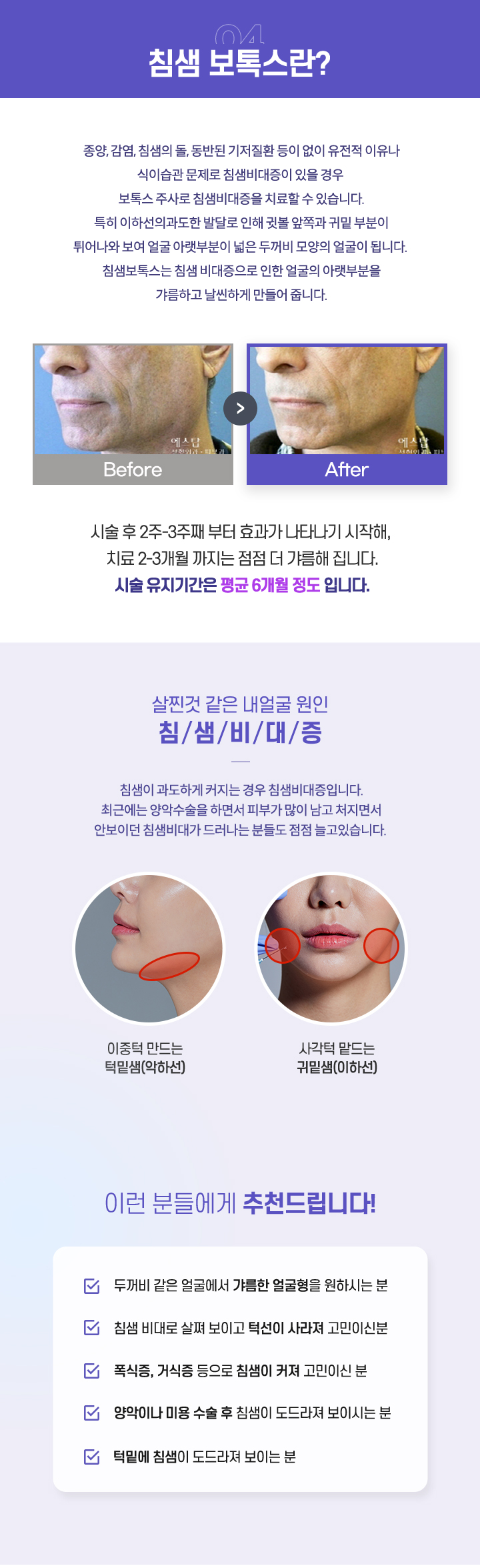 침샘보톡스란