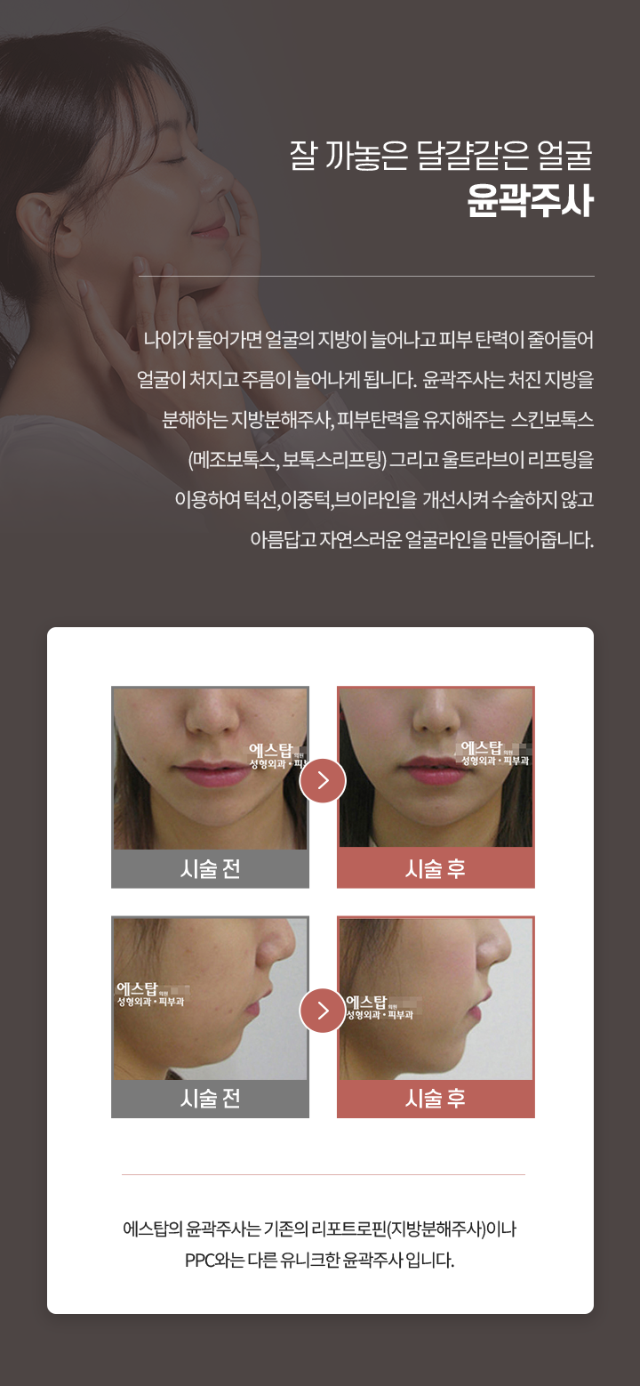 에스탑 비포에프터