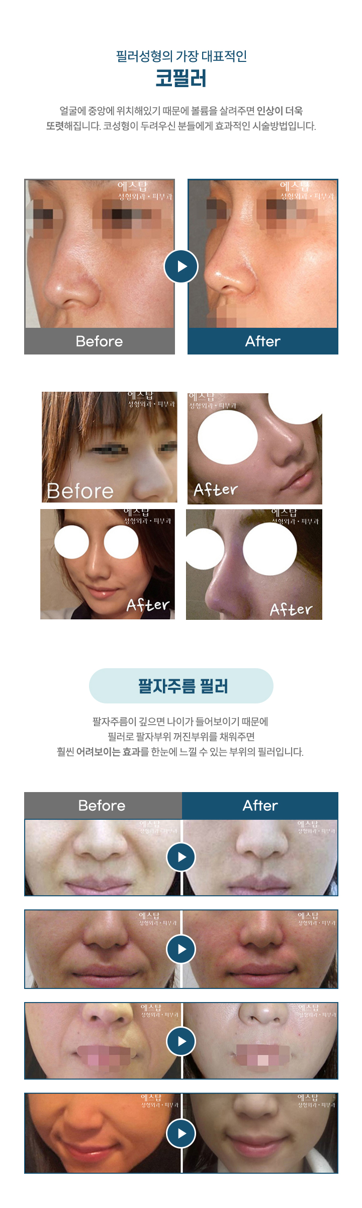 에스탑 코필러, 팔자주름필러
