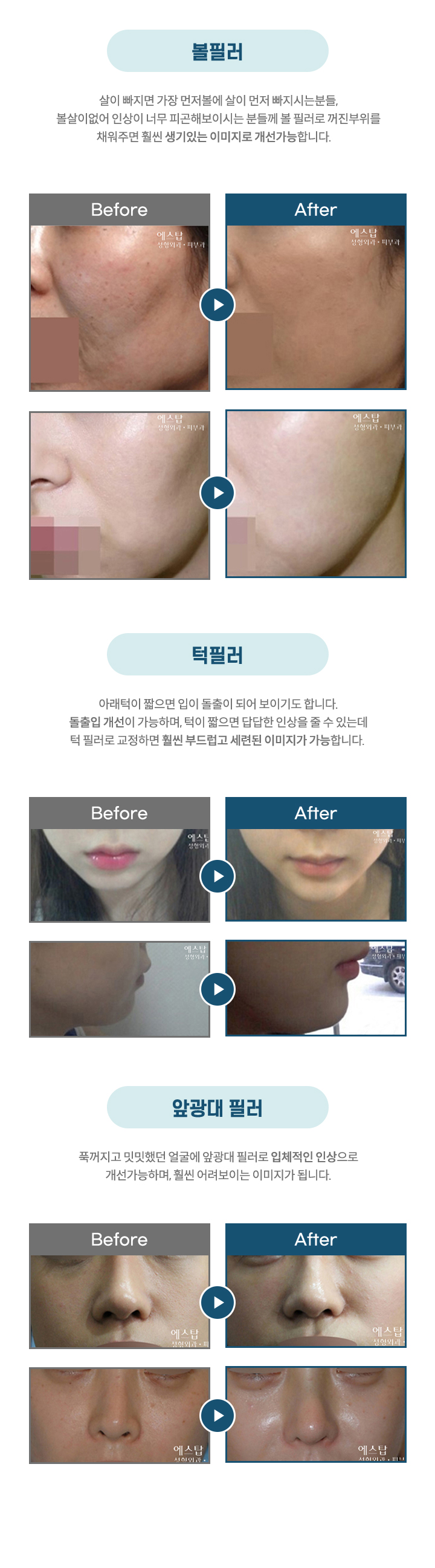 에스탑 볼필러, 턱필러, 앞광대 필러